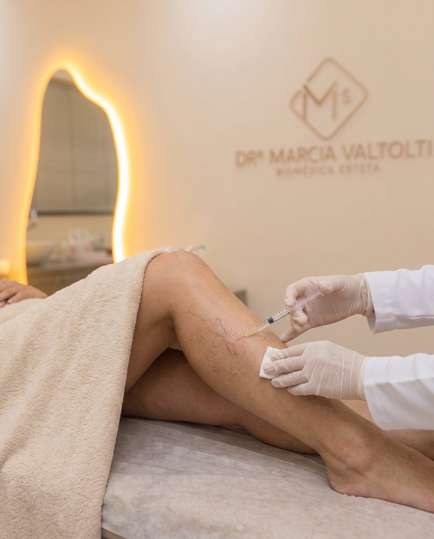 Aplicação com seringa em pequenos vasos superficiais da perna, com luvas de proteção